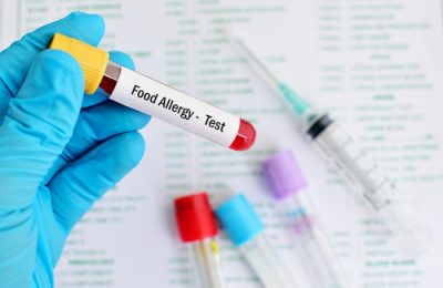 Things You Never Heard About A Food Allergy Test